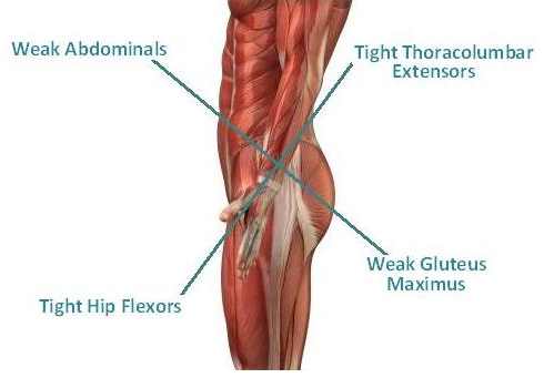 LOWER CROSSED SYNDROME