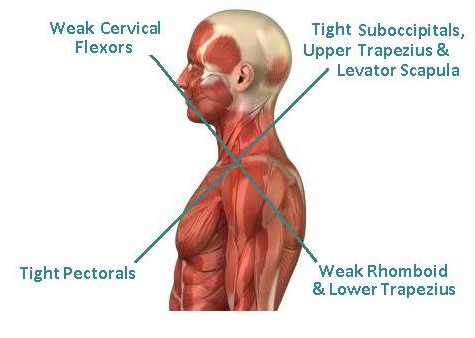 UPPER CROSSED SYNDROME